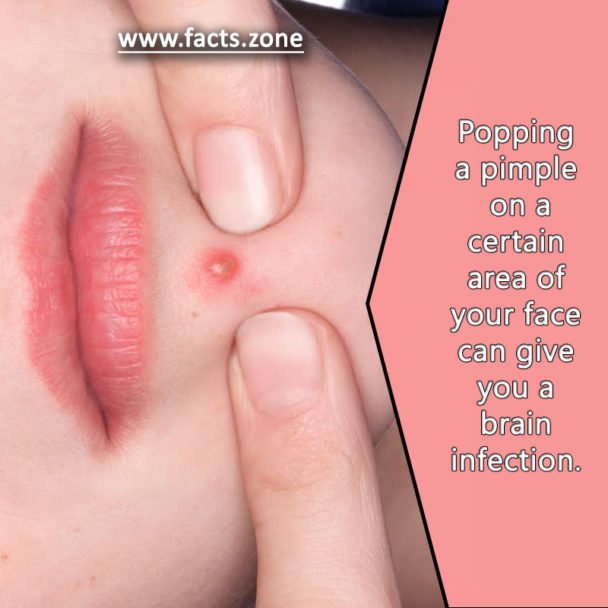 Popping a pimple can give you a brain infection.